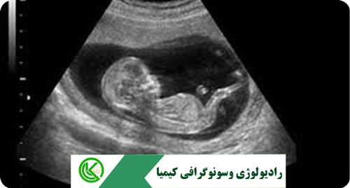 فواید سونوگرافی جنین در بارداری