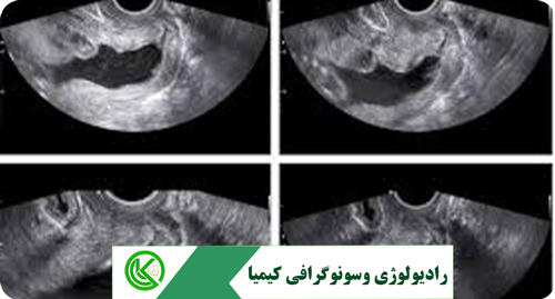 سونوگرافی آنومالی اسکن ۲ بعدی (ANOMALY SCAN) 