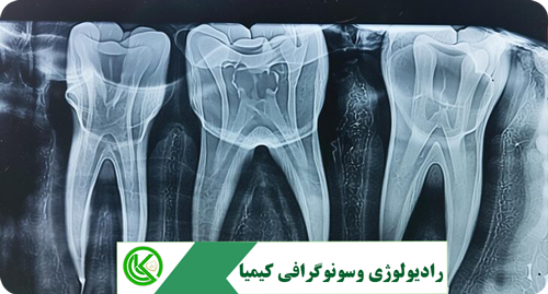 رادیوگرافی پری اپیکال یا تک دندان چیست؟